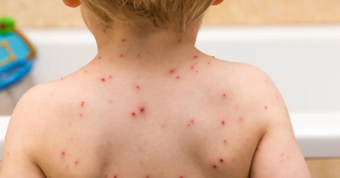 Kenali Tanda Awal Cacar Air yang Sering Terlewat dan Mudah Disepelekan