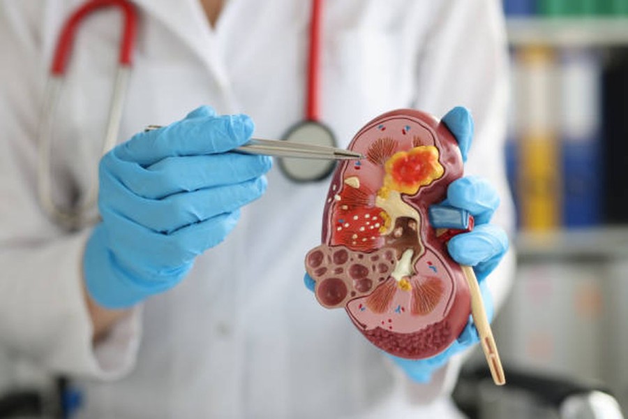 Minum Air Berlebihan Bisa Ganggu Fungsi Ginjal, Ini Penjelasan Dokter