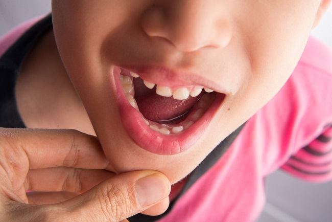 Tumbuhnya Gigi Susu pada Anak: Fakta Seputar Pertumbuhan dan Penyebab Anak Sering Mengeluarkan Air Liur