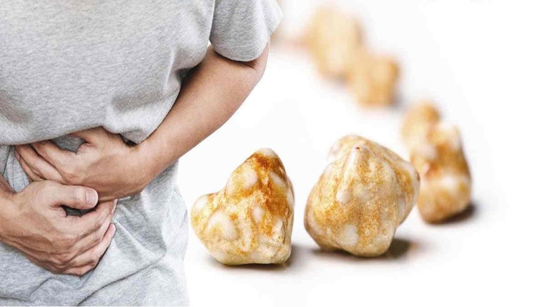 Kenali Gejala Batu Empedu Sejak Dini dan Cara Efektif Pencegahnya