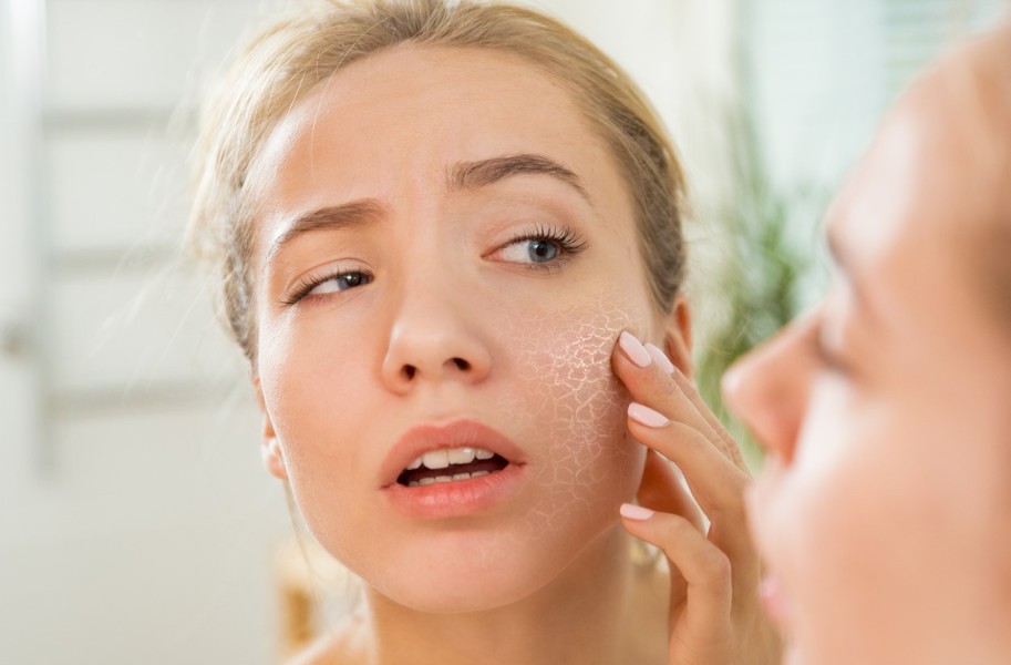 Simak 5 Cara Alami Merawat Kulit Kering Saat Cuaca Dingin Agar Tetap Lembap