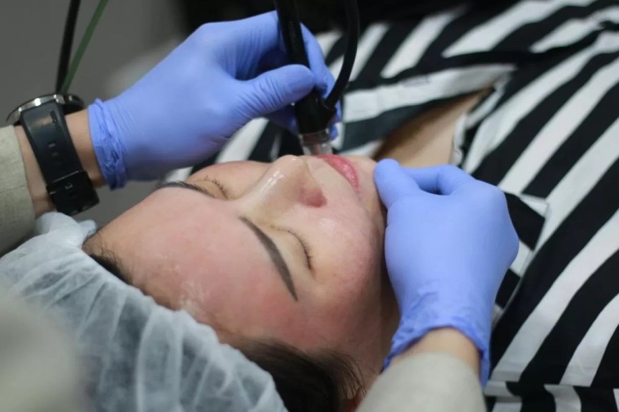 Cara Mengatasi Flek Hitam dan Hiperpigmentasi Kulit Masyarakat Tropis