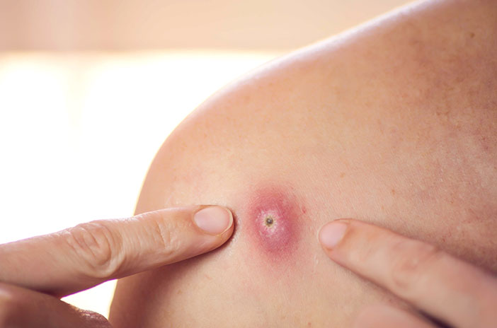 5  Cara Aman Menghilangkan Bisul Mengeras Tanpa Dipecahkan