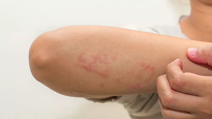 Mengungkap Fakta Dermatitis Atopik dan Cara Pencegahannya