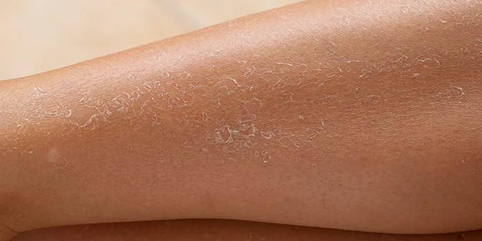 Cara Alami Mengatasi Kulit Kering di Tangan dan Kaki