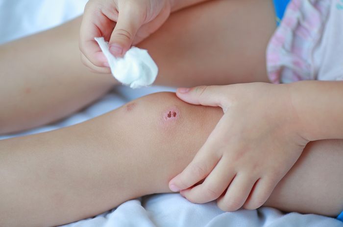 Risiko Mengoleskan Air Liur pada Luka Anak Menurut Dokter