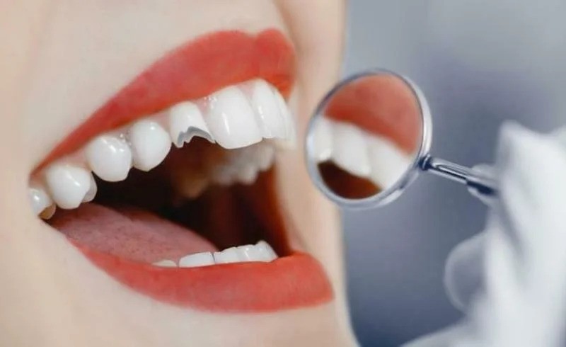 Masalah Kesehatan Gigi Paling Umum di Indonesia Terungkap