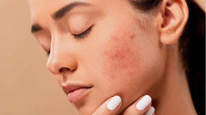 Kenali Gejala Rosacea dan Cara Tepat Merawat Kulit Sensitif