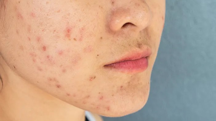 Langkah Tepat Atasi Bekas Jerawat Setelah Dipencet Agar Kulit Kembali Mulus