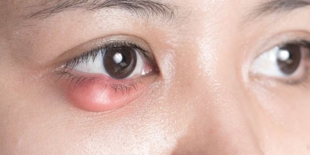 8 Penyebab dan Cara Mengatasi Kelopak Mata Bawah Bengkak