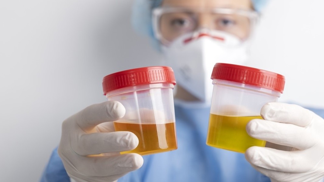 Mengenali Gejala Awal Gangguan Ginjal dari Warna Urine