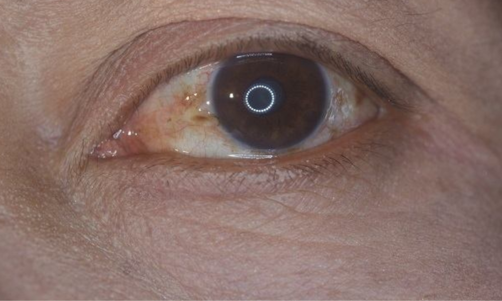 Kenali Berbagai Faktor Risiko yang Menyebabkan Lemak Mata dan Pencegahannya