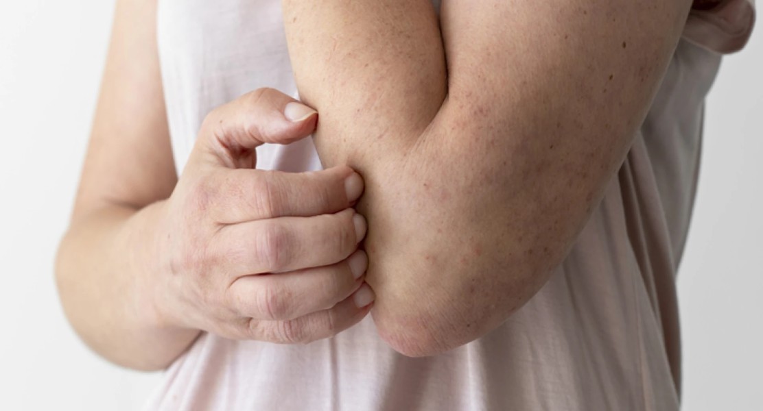 Kenali Gatal dan Gejala Lain yang Bisa Jadi Tanda Diabetes Tersembunyi