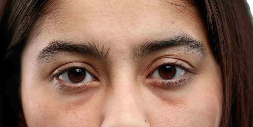 Tips Efektif Mengatasi Lingkaran Hitam pada Bawah Mata Secara Alami