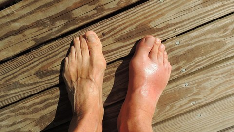 5  Rutinitas Pagi Efektif Turunkan Risiko Asam Urat Kambuh