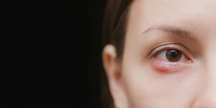 Strategi Tepat Mengatasi Kalazion Agar Mata Tetap Sehat dan Bersih