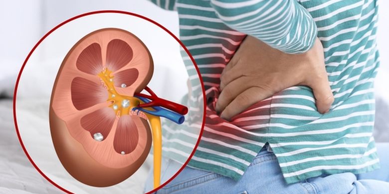 Memahami Hubungan Asam Urat dan Batu Ginjal, Pahami Gejala serta Pencegahannya Alami