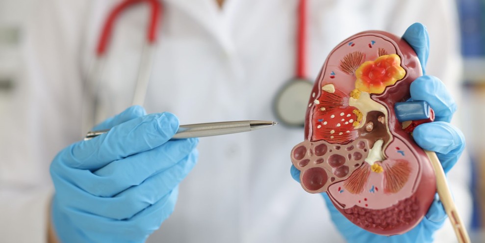 Perhatikan 5 Kebiasaan Sepele yang Bisa Menyebabkan Batu Ginjal