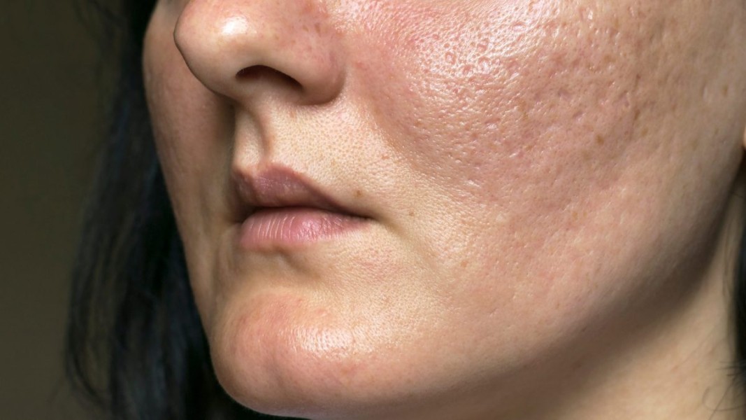 5 Cara Ampuh Menghilangkan Bopeng Bekas Jerawat yang Ampuh dan Bikin Wajah Mulus