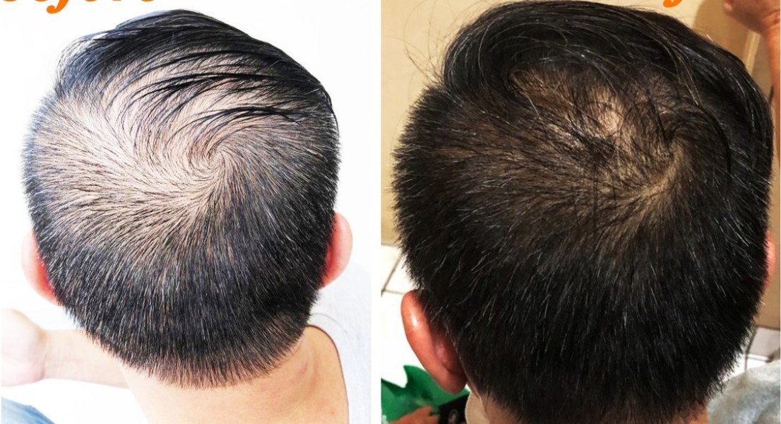 Ragam Jenis Obat Penumbuh Rambut Botak Alami dan Kimiawi