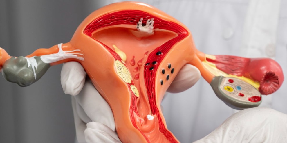 3 Gangguan Reproduksi Tersembunyi yang Sering Tidak Terdiagnosis pada Perempuan