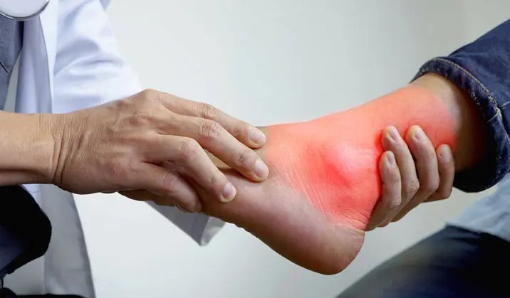 Perlukah Operasi Tofi untuk Penderita Asam Urat, Ini Penjelasannya