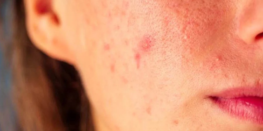5 Cara Mudah Hilangkan Kemerahan pada Wajah Secara Alami