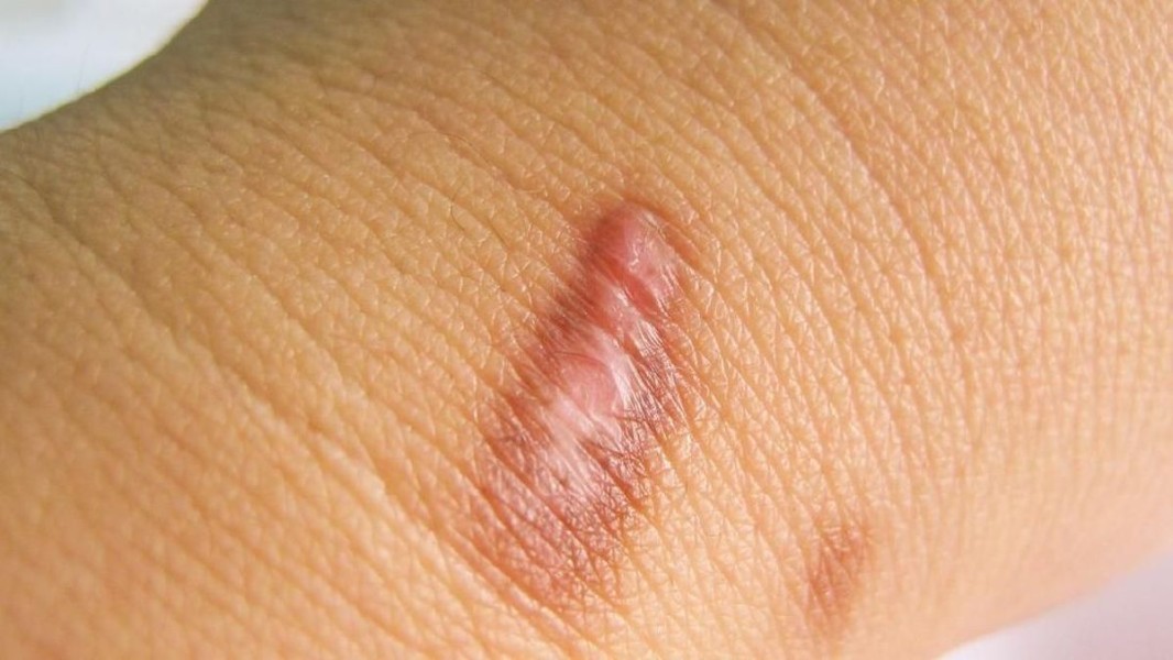 Mengenal Penyebab Keloid, Ciri, dan Cara Menghilangkannya