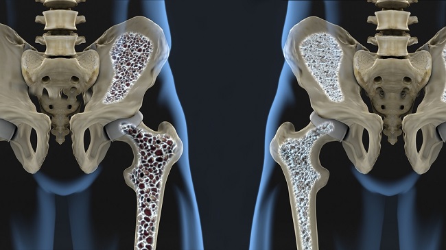 7 Penyebab Osteoporosis, Gejala, hingga Cara Mencegahnya