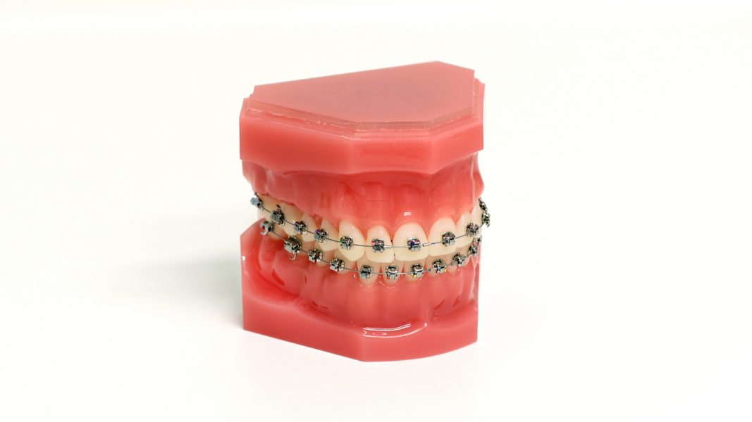 Rekomendasi Warna Behel yang Lagi Trend, Pilih yang Sesuai dengan Gayamu!