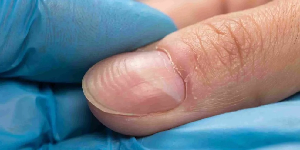 Permukaan Kuku Bergelombang Sering Terjadi Akibat Faktor Ini