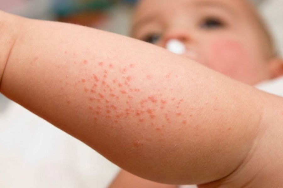 Eksim Bukan Sekadar Masalah Kulit, Kenali Gejala dan Penanganannya Tepat