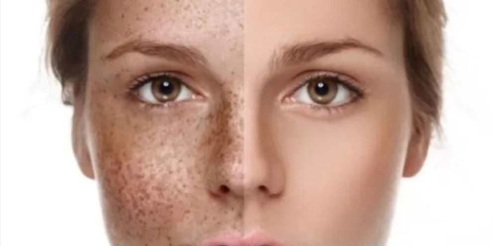 6 Cara Agar Flek Hitam di Wajah Cepat Mengelupas dan Memudar