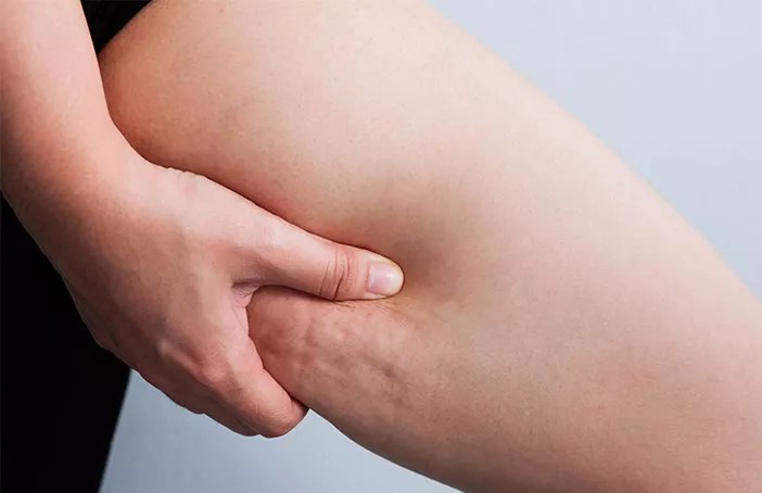 Ini 9 Cara Mengurangi Selulit Kulit yang Bisa Dicoba Secara Alami