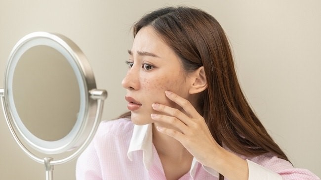 Mengungkap Penyebab Flek Hitam Muncul Meski Jerawat Tidak Pernah Dipencet