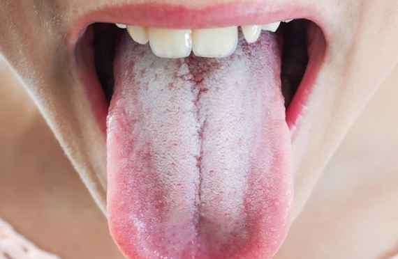 Lidah Terasa Pahit? Kenali 7 Kondisi Medis Penyebabnya