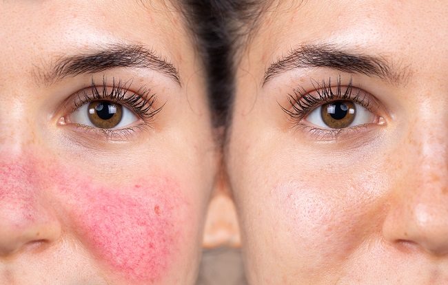 Rosacea Penyebab Wajah Merah Kronis dan Cara Mengatasinya