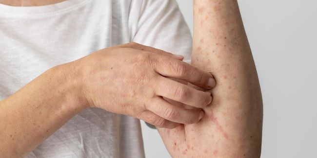 Kemenkes Waspada, Kasus Campak Menurun namun Pemantauan Tetap Intensif