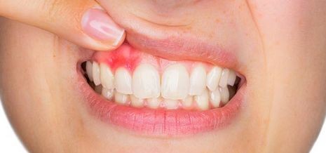 Abses Gigi: Kenali Penyebab, Gejala, dan Cara Pencegahan Efektif