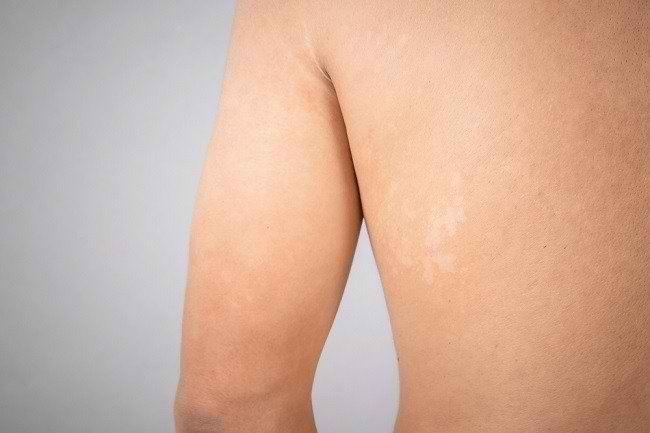 Cara Ampuh Mengatasi Panu dan Merawat Kulit agar Terbebas dari Infeksi