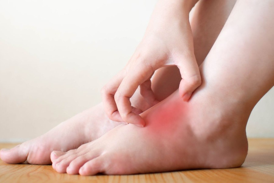 Penting Mengenali Perbedaan Gatal Biasa dan Gatal Diabetes Sejak Dini