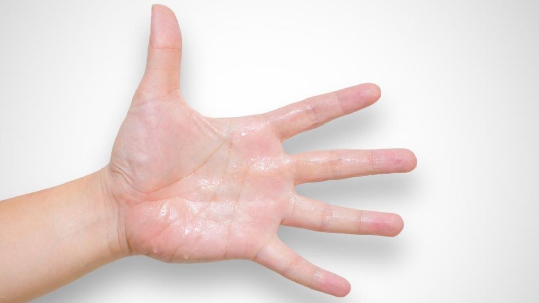 Telapak Tangan Basah Tidak Selalu Pertanda Penyakit Jantung