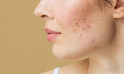 Ternyata Ini 15 Penyebab Breakout Pada Kulit yang Sering Luput Disadari