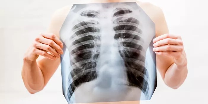 Kenali Gejala Kanker Paru Sejak Awal untuk Penanganan Cepat dan Tepat