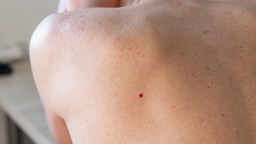 Steven Johnson Syndrome adalah: Gejala, Risiko, dan Penyebab