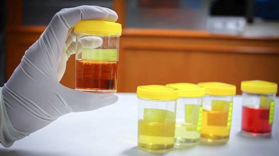 5 Ciri-ciri Urine yang Menunjukkan Adanya Gangguan Ginjal yang Harus di Waspadai