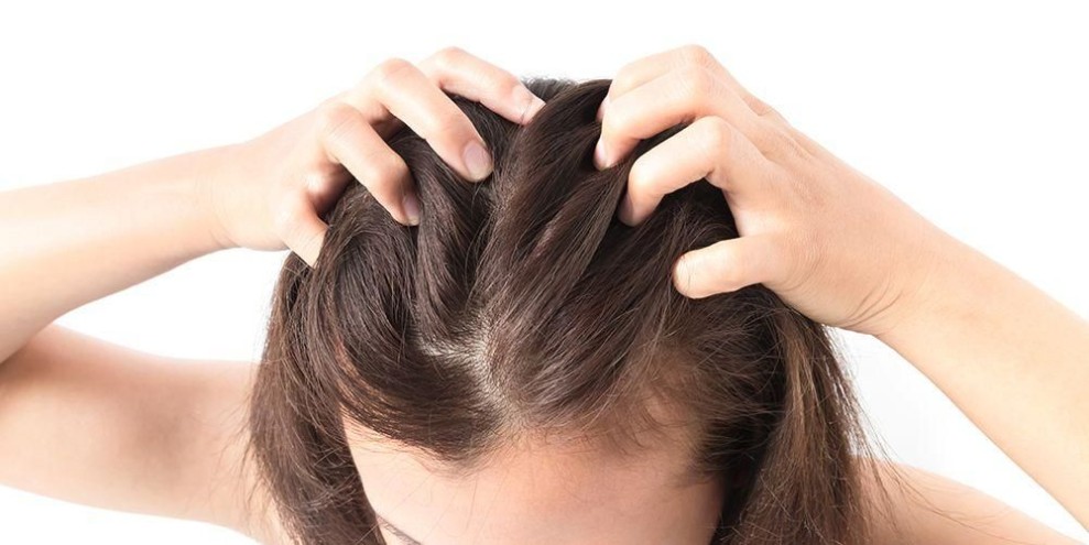 Langkah Efektif Mengatasi Jerawat di Kulit Kepala agar Tidak Kambuh Lagi