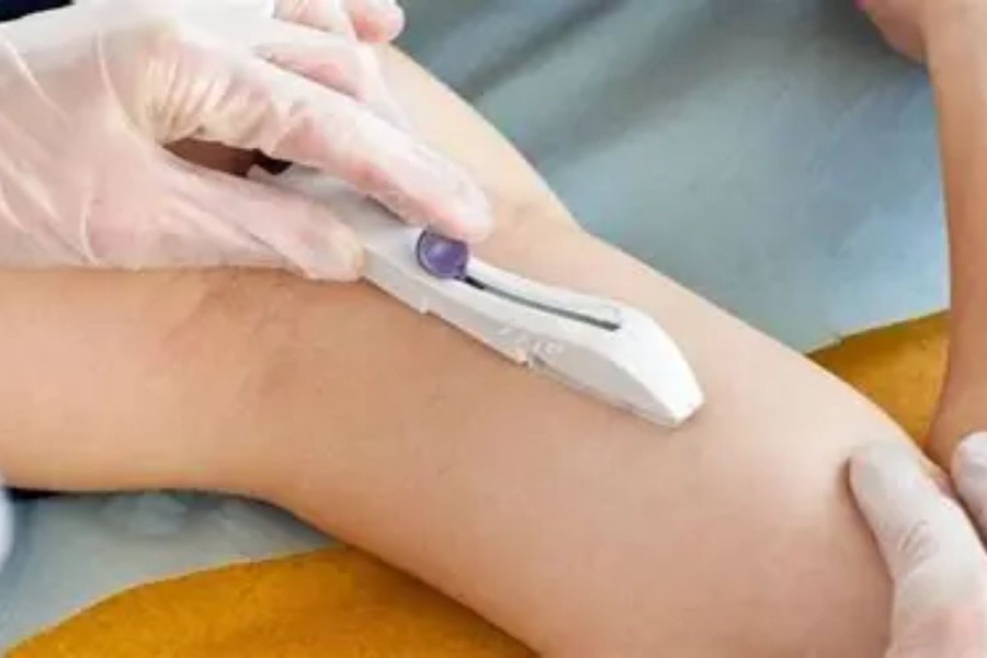 Ini Kelebihan dan Kekurangan KB Implan, Cara Pasang & Efek Sampingnya