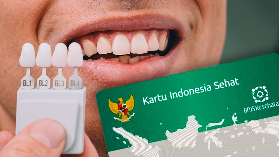 Inilah Cara Mendapatkan Subsidi Pasang Gigi Palsu dari BPJS Kesehatan