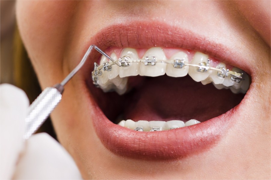 Jangan Asal Tren, Ini 7 Kondisi Gigi yang Memang Disarankan Pasang Behel